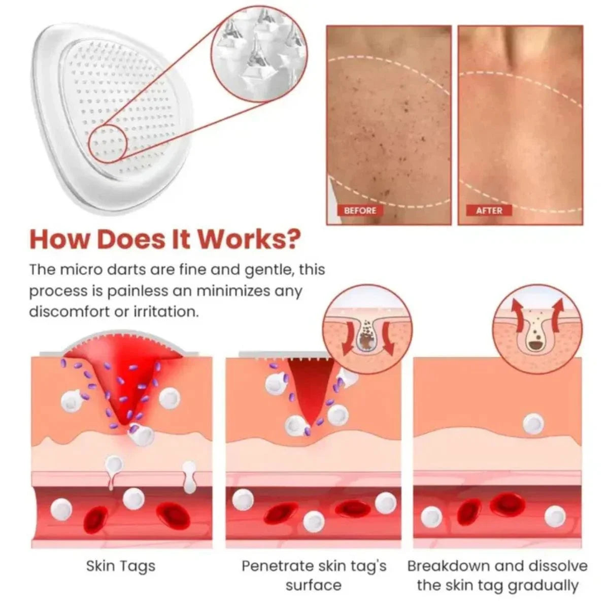 DermaSmooth Skin Tag Remover Patch | Fast, Safe & Painless Skin Tag & Mole Removal | Nano-Microneedle Technology | 72 Patches